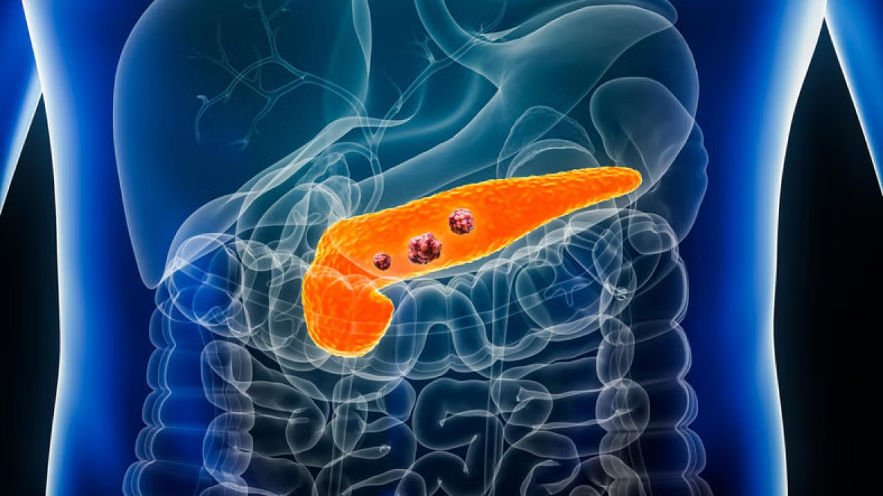 Graphic illustration of a human pancreas. Here the pancreas is orange inside a human body shown in blue with other organs nearby.